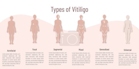 Illustration for Types of vitiligo .silhouette and on it marked affected area with a lighter shade.space for text on light background. - Royalty Free Image