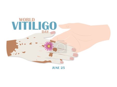 Illustration for World Vitiligo Day.June 25.Two hands joining hands on a white background, one of them with vitiligo and one without to avoid the stigmatization of this disease. - Royalty Free Image