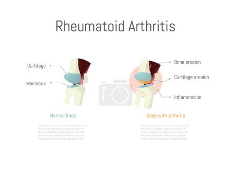Téléchargez les illustrations : Infographie de la façon dont la polyarthrite rhumatoïde affecte le genou, les os, le cartilage et provoque l'inflammation. - en licence libre de droit