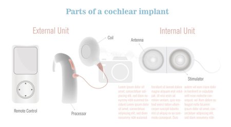 Ilustración de Partes de un implante coclear desde el mando a distancia, la parte externa que se coloca en el oído y luego la parte interna que se implanta en la cabeza. - Imagen libre de derechos