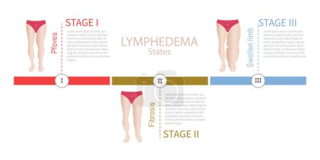 Ilustración de Diferentes etapas del linfedema de piernas - Imagen libre de derechos