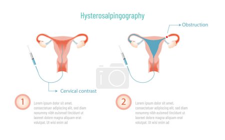 Hysterosalpingography process, two steps .Vector eps10