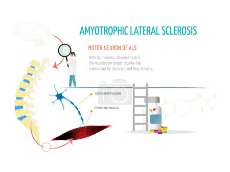 A doctor looks at a spinal column with a magnifying glass. She checks that the signal from the brain does not reach the muscle due to the disease. Amytrophic lateral sclerosis concept.
