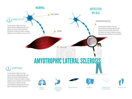 A doctor looks at a diagram of the human body. The diagram shows the muscles and nerves of the body. Amytrophic lateral sclerosis concept