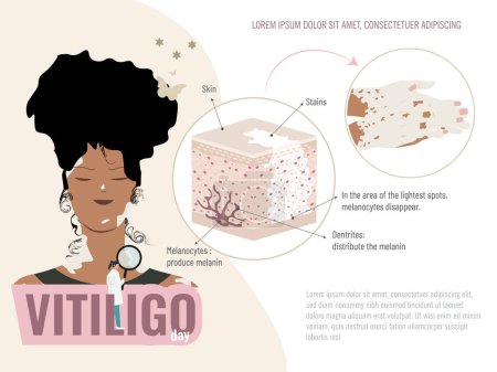 A woman with black hair and a green shirt is shown with an illustration of a skin condition called vitiligo. Graphic scheme of the skin with this disease.Vitiligo disease education concept
