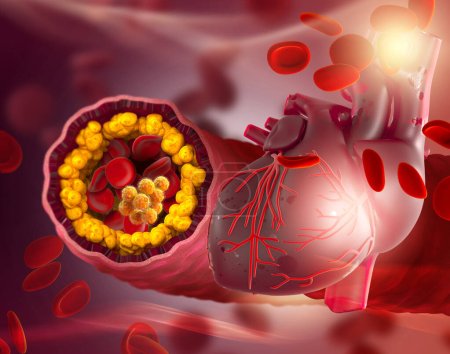 Medizinischer Hintergrund, Cholesterinplaque in der Arterie, erhöhter Spiegel, 3D-Illustration