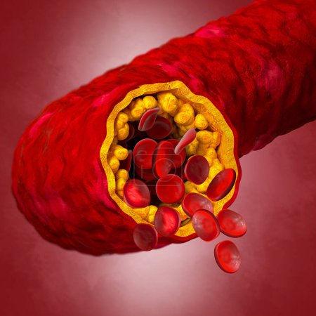 Photo for Medical background, cholesterol plaque in the artery, increased level, 3d illustration - Royalty Free Image