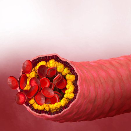 Foto de Antecedentes médicos, placa de colesterol en la arteria, aumento del nivel, ilustración 3d - Imagen libre de derechos