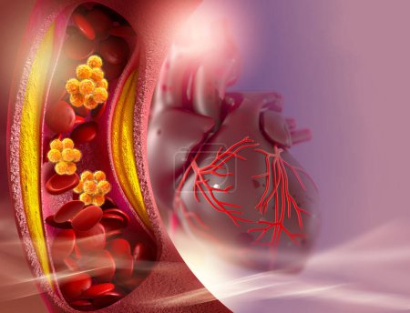 Medical background, cholesterol plaque in the artery, increased level, 3d illustration