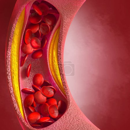 Antecedentes médicos, placa de colesterol en la arteria, aumento del nivel, ilustración 3d
