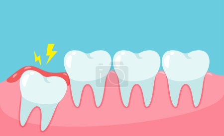 Illustration for Impacted wisdom tooth cause pain in the mouth.Dental care concept - Royalty Free Image