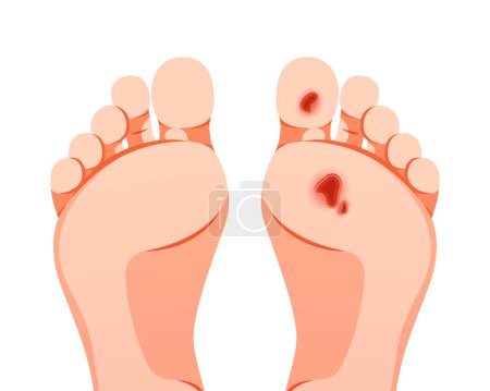  Ulcères du pied diabétique vecteur isolé sur fond blanc.