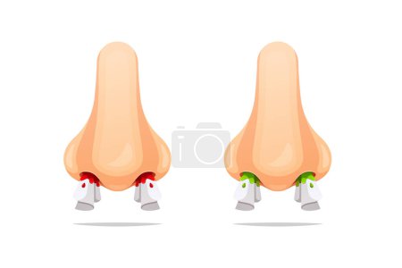 Nose bleeds and runny nose with tissue vector isolated on white background.