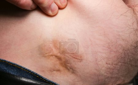 Téléchargez les photos : Une vilaine cicatrice sur le gros ventre de l'homme après l'opération de l'appendicite. Vieux keloïde sur le ventre. Traitement médical maladie photo. - en image libre de droit