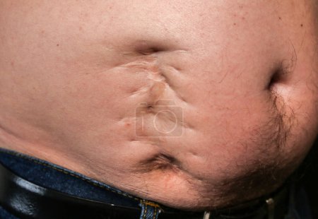 Téléchargez les photos : Une vilaine cicatrice sur le gros ventre de l'homme après l'opération de l'appendicite. Vieux keloïde sur le ventre. Traitement médical maladie photo. - en image libre de droit