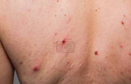 Muchas marcas de nacimiento en la espalda de la chica. Foto de salud médica. Piel grasa de la mujer con problemas de acné.