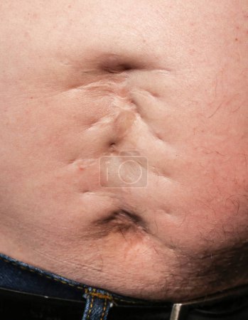 Ugly bad scar on the man's fat belly after the appendicitis surgery. Old keloid on the stomach. Medical treatment disease photo.