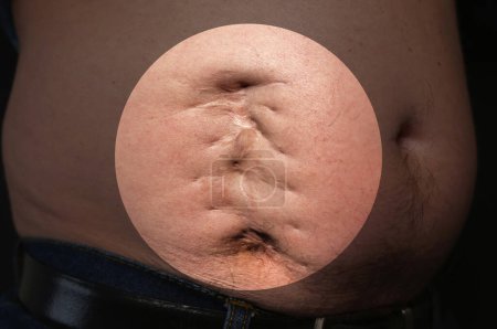 Ugly bad scar on the man's fat belly after the appendicitis surgery. Old keloid on the stomach. Medical treatment disease photo.