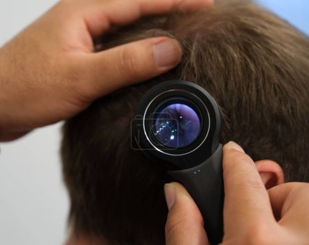 Foto de El médico examina los folículos pilosos del paciente con lupa para trasplante de cabello.. - Imagen libre de derechos