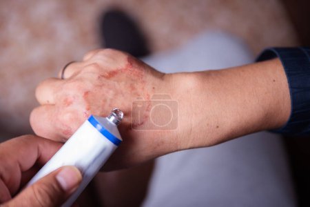 Curing with an allergic reaction cream on the hand.