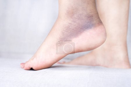 Nahaufnahme des Fußschmerzes einer Frau, die an einem verstauchten Knöchel leidet, der anschwillt und blutet