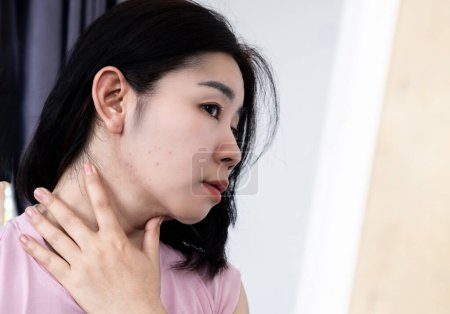 Photo for Asian woman have problem with  acne along the jawline checking her face in a mirror - Royalty Free Image