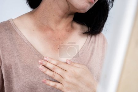 Nahaufnahme Frau haben Probleme mit Sonneneinstrahlung, Sonnenbrand am Hals, Überprüfung ihrer dunklen Stelle und beschädigte Haut aus einem Spiegel 