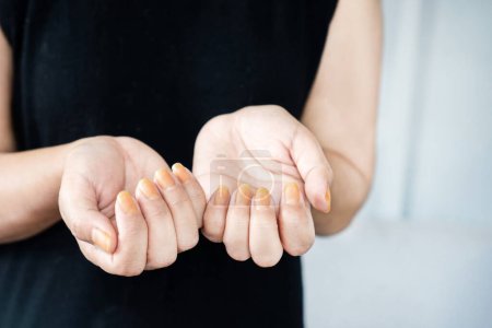 Nahaufnahme Frau zeigt gelben Nagelpilz verursacht durch das Tragen von Nagellack oder Rauchen langfristig 