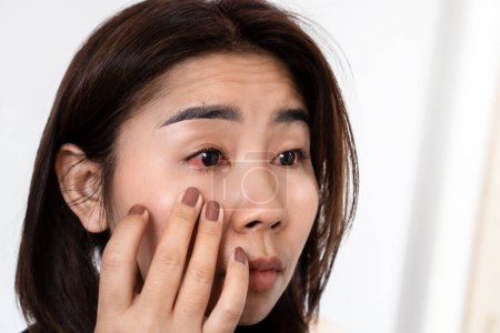 Mujer asiática que sufre de inflamación ocular sensación de dolor, enrojecimiento e hinchazón