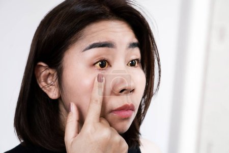 Foto de Mujer asiática revisando su concepto de ojos amarillos de ictericia ojos o hepatitis viral - Imagen libre de derechos