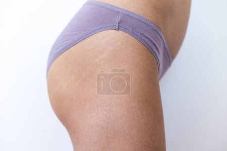 Foto de Cuerpo femenino con estrías en las nalgas, estrías en la piel después de perder peso, cambios en la piel posparto - Imagen libre de derechos