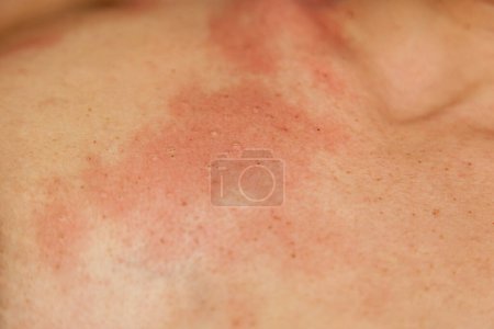 Photo for Consequences of removing papillomas on the girl's body with an electrocoagulator, burning them with high-frequency current. - Royalty Free Image