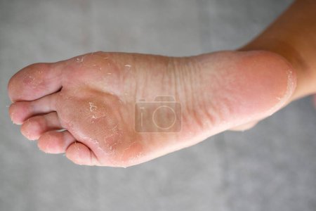 Close up of legs of an adult woman with skin peeling after a bath. Exfoliation of the damaged dermis. Health, skin and feet care concept.