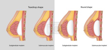 Illustration for Subglandular and Submuscular Breast Implants. Breast implant shapes Teardrop shape and Round shape. Breast implant types. - Royalty Free Image