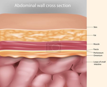 Abdominal wall cross section Anatomy. Abdominal wall layers Medical Illustration