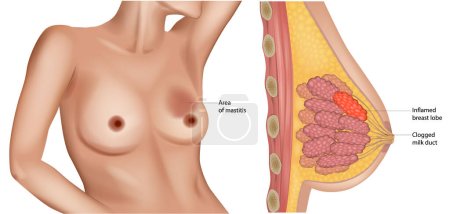 Mastitis. Corte transversal de la glándula mamaria con inflamación de la mama. Formación de abscesos. Un conducto lácteo trabado. Lóbulo inflamado de la mama.