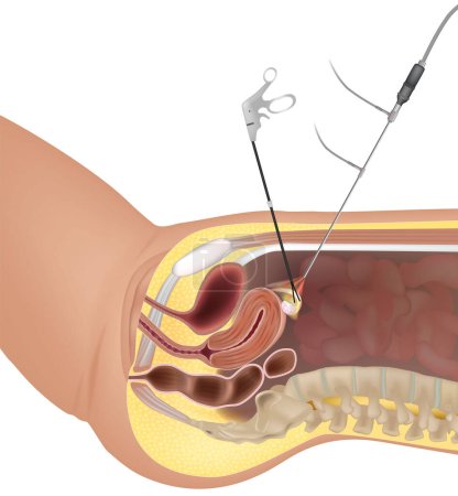 Illustration for Gynaecological Laparoscopy procedure. Laparoscopic instruments. Hysteroscopy Surgery. Fertilization by extracting eggs. - Royalty Free Image