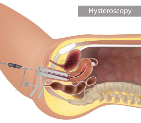 Illustration for Anatomic illustration of a modern hysteroscopic procedure. Inspection of the uterine cavity by endoscopy. Hysteroscopy procedure - Royalty Free Image