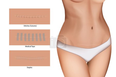 Illustration for Closeup of incision with sutures. Wound closure devices Staples, Medical Tape and Stitches or Sutures. Surgical wound - Royalty Free Image