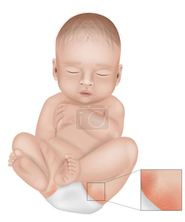 Diaper Rash or Irritant Diaper Dermatitis. Inflammation of the skin under a diaper. Jacquet Dermatitis. Infant with diaper rash in groin area.