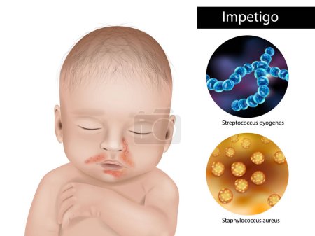 Ilustración de Impetigo is an infection caused by strains of staphylococcus or streptococcus bacteria. Impetigo skin infection affect infant. - Imagen libre de derechos