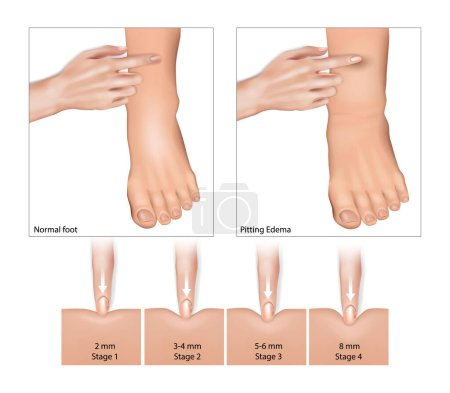 Illustration for Pitting Edema and Normal foot. Oedema, fluid retention, water retention, dropsy, hydropsy, swelling. Build-up of fluid in the bodys tissue. - Royalty Free Image