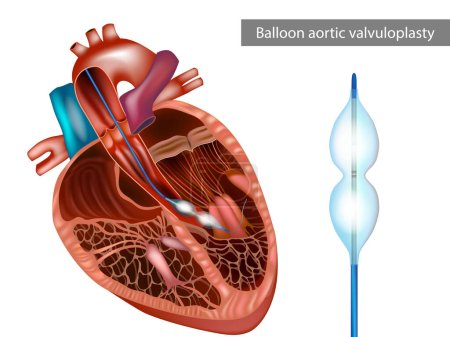 Illustration for Balloon aortic valvuloplasty or BAV. The balloon catheter is advanced. Increase aortic valve area and systemic blood flow. Aortic stenosis, or narrowing of the aortic valve. - Royalty Free Image