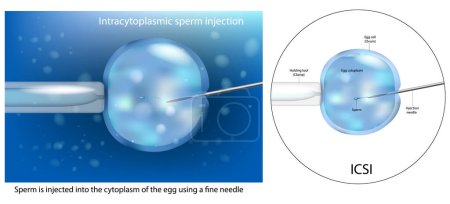 Téléchargez les illustrations : La procédure d'injection intracytoplasmique de sperme ICSI. Insémination artificielle fécondation in vitro. macro FIV. Diagramme scientifique - en licence libre de droit