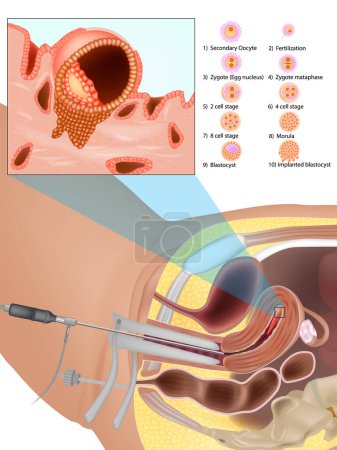Ilustración de Procedimiento de transferencia de embriones. Proceso de fertilización in vitro. Fertilización in vitro FIV - Imagen libre de derechos