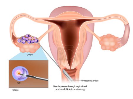 Illustration for IVF Egg Retrieval technique. Egg retrieval procedure before in vitro fertilization. Follicle, Ovary. - Royalty Free Image