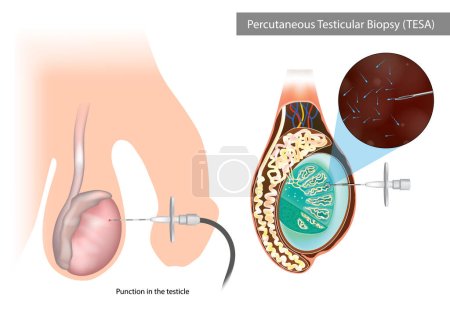 Illustration for PercutanPercutaneous Testicular Biopsy or TESA. Punction in the testicle. Surgical Sperm Retrieval Methods eous Testicular Biopsy or TESA. Punction in the testicle. Surgical Sperm Retrieval Methods - Royalty Free Image