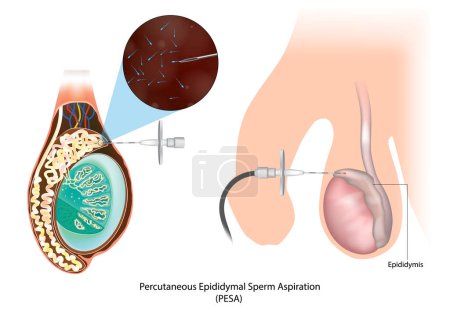 Téléchargez les illustrations : Percutaneous Epididymal Sperm Aspiration PESA. Biopsie testiculaire. Épididyme. Azoospermie. Techniques de récupération des spermatozoïdes chez les mâles azoospermiques - en licence libre de droit