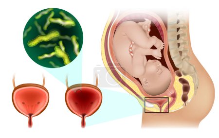 Ilustración de Infección del tracto urinario durante el embarazo. Cistitis aguda e intersticial. Urología. Infección de vejiga - Imagen libre de derechos