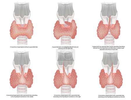 Ilustración de Ilustración de la clasificación de las formas de la glándula tiroides. Variaciones anatómicas y tipos de glándula tiroides y lóbulo piramidal. Características morfológicas del lóbulo piramidal - Imagen libre de derechos